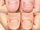 劇 的☆深爪改善!before→after