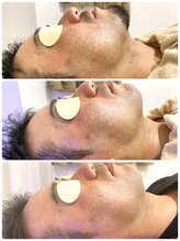 ラカ 稲葉店(LaKa)/メンズ顔脱毛