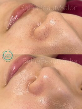 レーヌ(Reine)/毛穴エクストラクションフォトRF