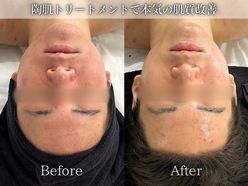 フェイシャルヴィム(FACIAL VIM)/肌質改善が得意です♪