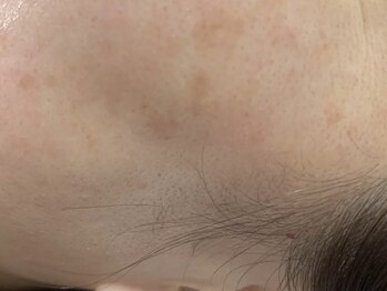 エミリー 守山店(EMILY)の写真/痛みを最小限に抑えた施術可能★当店のシミ改善は目元やまぶたのシミ・しわケアにも対応◎