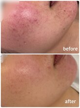 スムース(smooth)/ニキビ肌改善