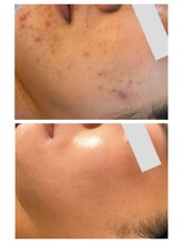 ナースセレクトサロン(Nurse select salon)/水光ピール