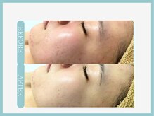 アコガレコガオ 秋田店/