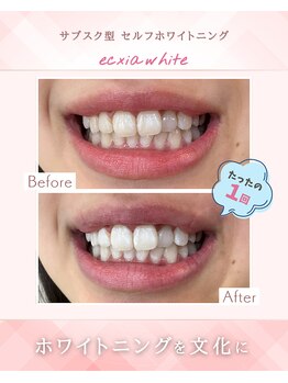 エクシアホワイトニング 浜松店/ホワイトニングビフォーアフター