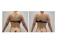 未来型スパエステ サリスパ(SARI SPA)/ビフォーアフター