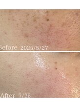 ブライス(BLITHE)/Before After