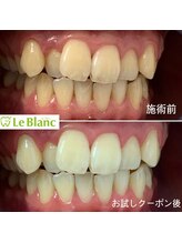 ルブラン 奈良店(Le Blanc)/2回照射後！