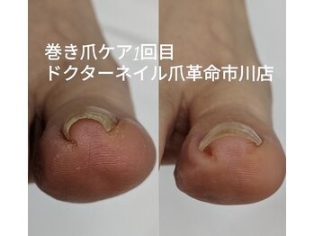 巻き爪ケア