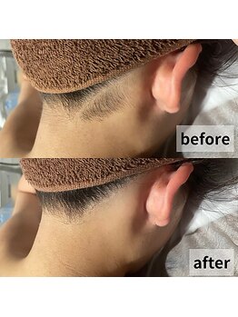 セイリキ(SEIRIKI)/うなじ脱毛