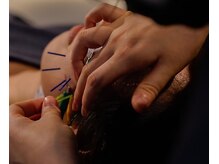 チョコバリ 渋谷店(chocobari)/小顔×リフトアップ(美容鍼)20代