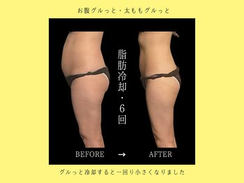 ブルースター 上小田井店(Blue Star)/脂肪冷却24カップ×6回