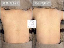 ラヴィオーラ 加古川店(La Viora)/ダイヤモンドハーブピーリング