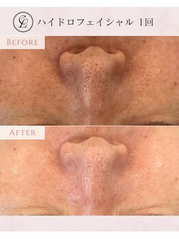 エンルーチェ(en;Luce)/毛穴ゴッソリくすみケアに◎