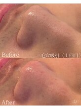 ソエル(Soel)/毛穴撲滅☆毛穴吸引