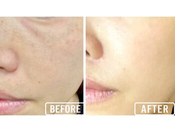 ビビ(VIVI)/ララピール症例