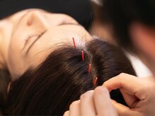 あたまの再起動/｢７割｣のお客さまが鍼未経験