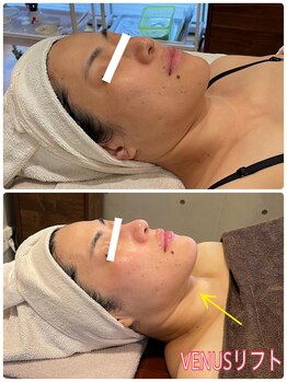 エクセレントビューティーサロン 艶(EN)/VENUSリフト＆アクアピーリング