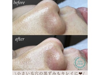 サロン ド ソワン(salon de soin)/小さな黒ずみもキレイに！