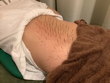 上野毛駅前整骨院 鍼灸院/腰への鍼