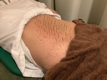 上野毛駅前整骨院 鍼灸院/腰への鍼