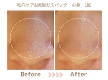 リトリト(Retreat)/毛穴ケア1回ビフォアフター