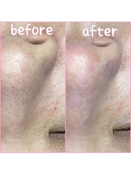 プラスボーテ 幡ヶ谷(plus beaute)/☆長年の黒ずみ毛穴の解消に☆