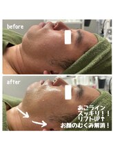 クラリ(Clari)/小顔/たるみ/浮腫み/リンパケア