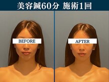 シンク 表参道(CINQ)/美容鍼灸60分1回の変化