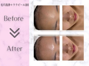 リライフ(ReLIFE)/韓国肌管理/毛穴洗浄+ララピール