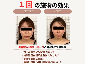 クローバー鍼灸整骨院/美容鍼+小顔矯正マッサージ