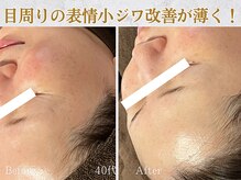 ぷるる 練馬 江古田/40代　ララ＋ゲルマスク導入