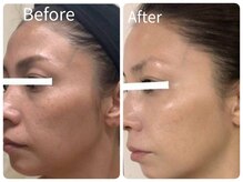 サロン ド ヒノキ(Salon de HINOKI)の雰囲気（剥離なしで磨き上げるハーブピーリング☆透明感を即実感！）