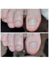 爪切り屋 足楽/諦めずに爪の成長を促します