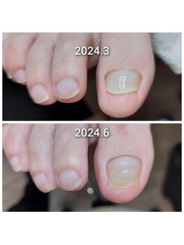 諦めずに爪の成長を促します