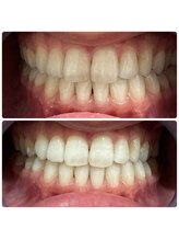 エクシアホワイトニング 日本橋店/初回