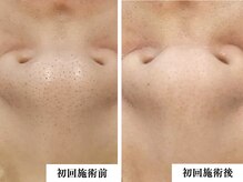 リコス(LICCO’S)/光フォト　1回施術直後の変化