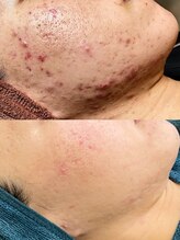 ソリッジ肌管理室/ニキビケアはソリッジ肌管理室