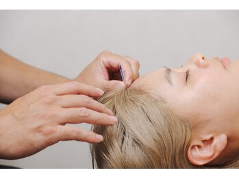 ジェネラス 鍼灸院 整骨院(GENEROUS)/頭部へ鍼