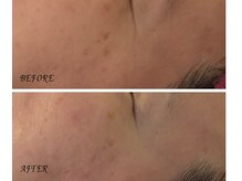 アイリーボーテ 東大阪(アイリーBEAUTE)/ヒト幹細胞導入＋炭酸パック