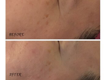 アイリーボーテ 東大阪(アイリーBEAUTE)/ヒト幹細胞導入＋炭酸パック