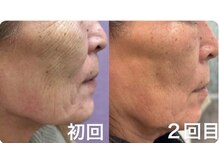 成長因子トリートメントで表面だけでなく体の細胞からエイジング