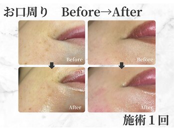 セレーノ 白金台(seReno)/潤艶Wax 口周りbefore/after
