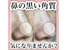 エミュローズ 段原店(Nm' Rose)/黒い角質が気になる方へ
