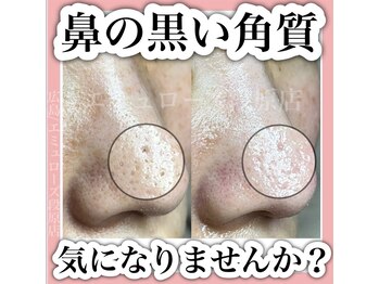 エミュローズ 段原店(Nm' Rose)/黒い角質が気になる方へ