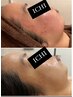【ニキビにお悩みの方】ニキビケア体験&カウンセリング2回体験