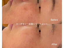 リアン(Lien)/カーボキシー炭酸トリートメント