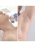 【メンズヒゲ+ワキ 光脱毛】青ヒゲ・ニオイ対策◎清潔感UP ¥8800
