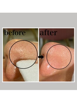 毛穴専科/ワックス脱毛メンズok/沖縄/那覇