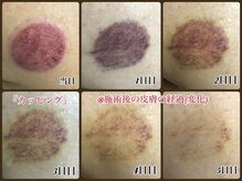 ナオ鍼灸院(Nao鍼灸院)/【カッピング】皮膚の経過(変化)